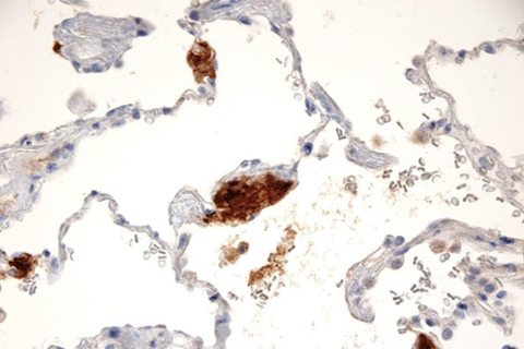 pulmonary and mediastinal pathology sample