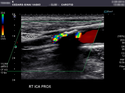 Doppler ultrasound: Uses, what to expect, and results