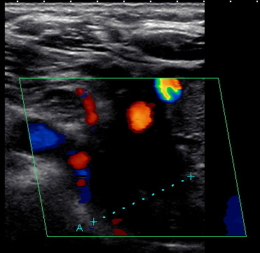 Doppler Ultrasound Exam Of Arm Or Leg: Purpose, Results, And More