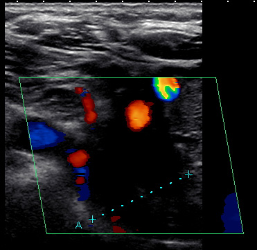 blood clot in leg ultrasound