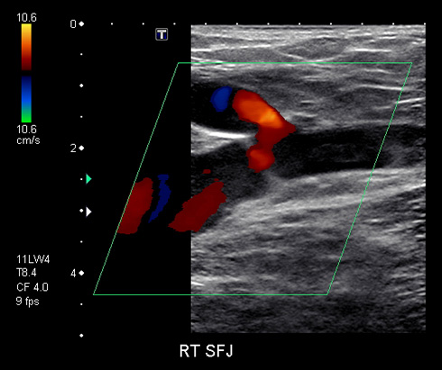 blood clot in leg ultrasound