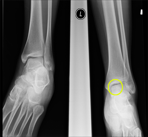 fractured ankle x ray