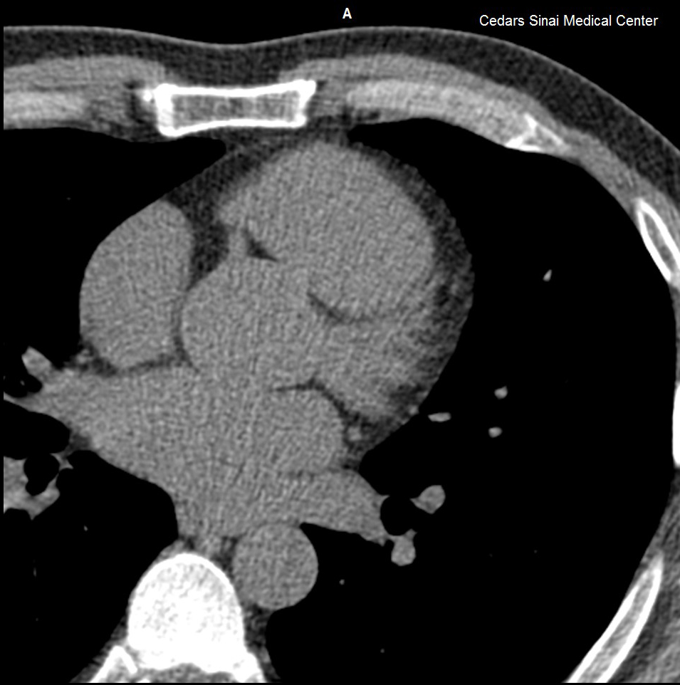 Coronary Calcium Scanning - Los | Cedars-Sinai