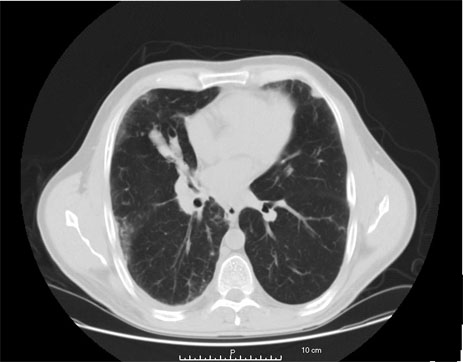 chest ct scan with contrast what does it show
