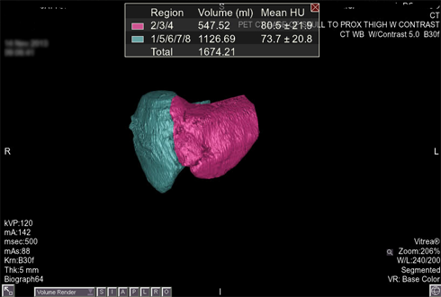Ct Of The Abdomen Pelvis Cedars Sinai
