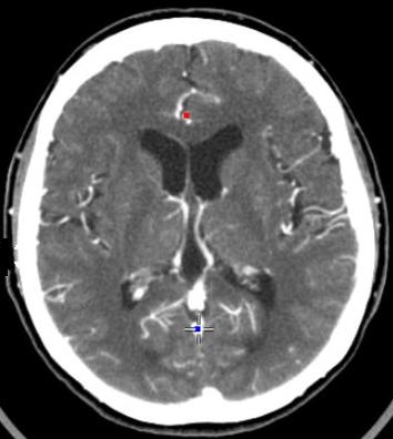 CT Brain with or without Contrast | Cedars-Sinai
