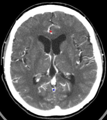 Automated detection of brain metastases on non-enhanced CT using