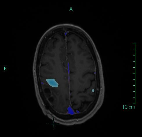 brain scan with tumor