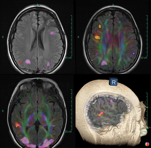 fMRI vs. SPECT Scan for the Brain