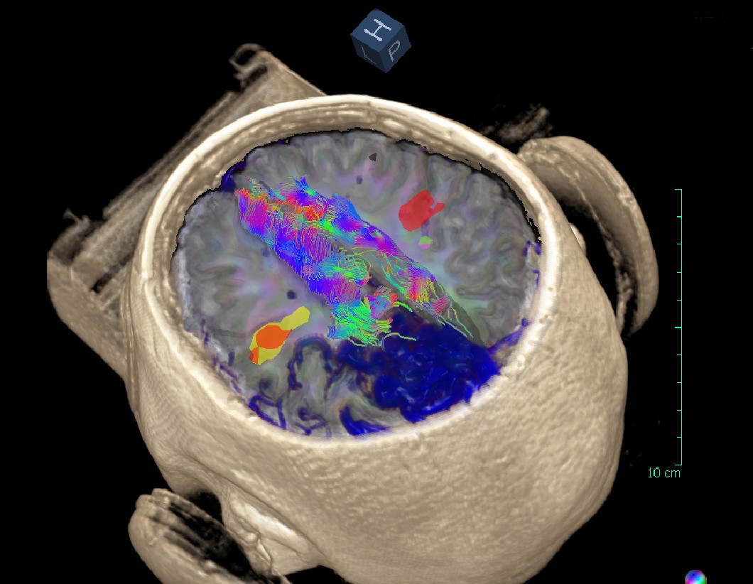 Functional MRI with DTI Fiber Tracking | Cedars-Sinai