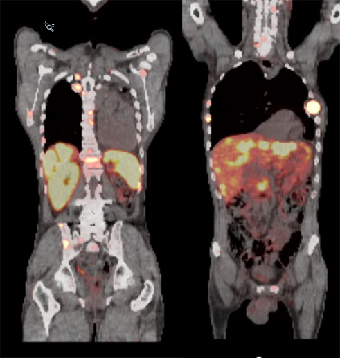netspot neoendocrine tumor santa fe netspot neoendocrine tumor santa fe