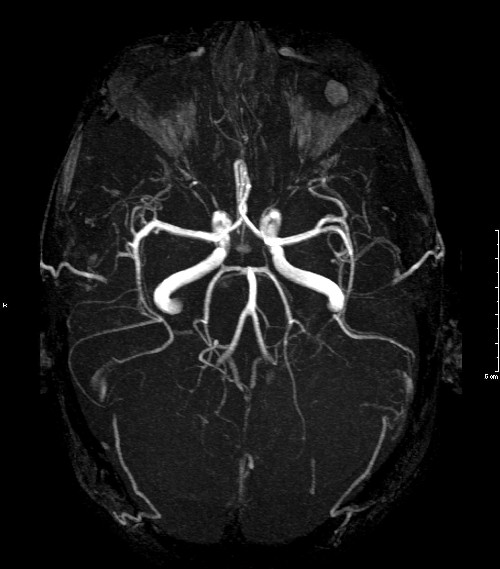 Kamel Hr rynker MR Angiography | Cedars-Sinai