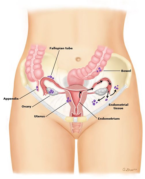 A medical illustration showing what an endometriosis MRI scans.