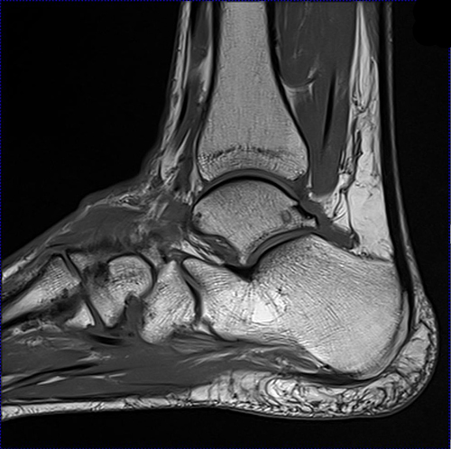 Mri Lower Extremities Leg Cedars Sinai