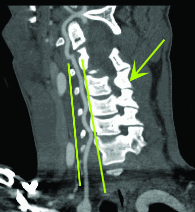 mesothelioma cancer operation