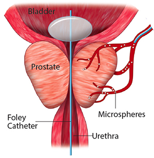 A medical illustration of prostate artery embolization.