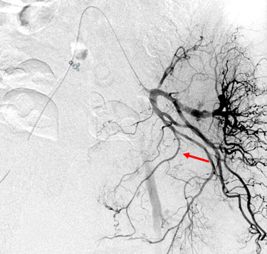 Imaging showing the prostate artery embolization procedure.