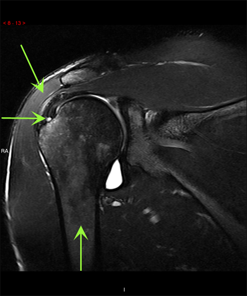 supraspinatus tear mri