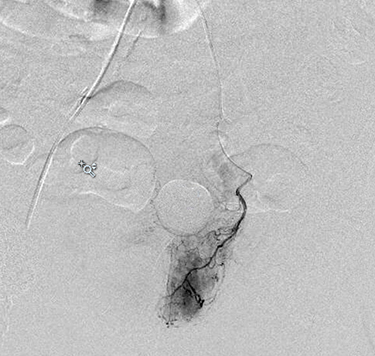 Imaging showing selective arteriogram of the left prostate artery and opacification of the left hemi-prostate.
