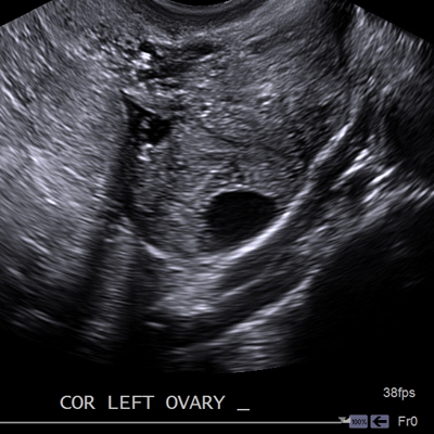 Transvaginal Cedars-Sinai