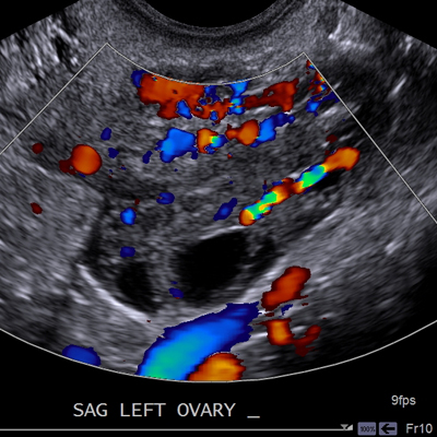 Transvaginal Cedars-Sinai