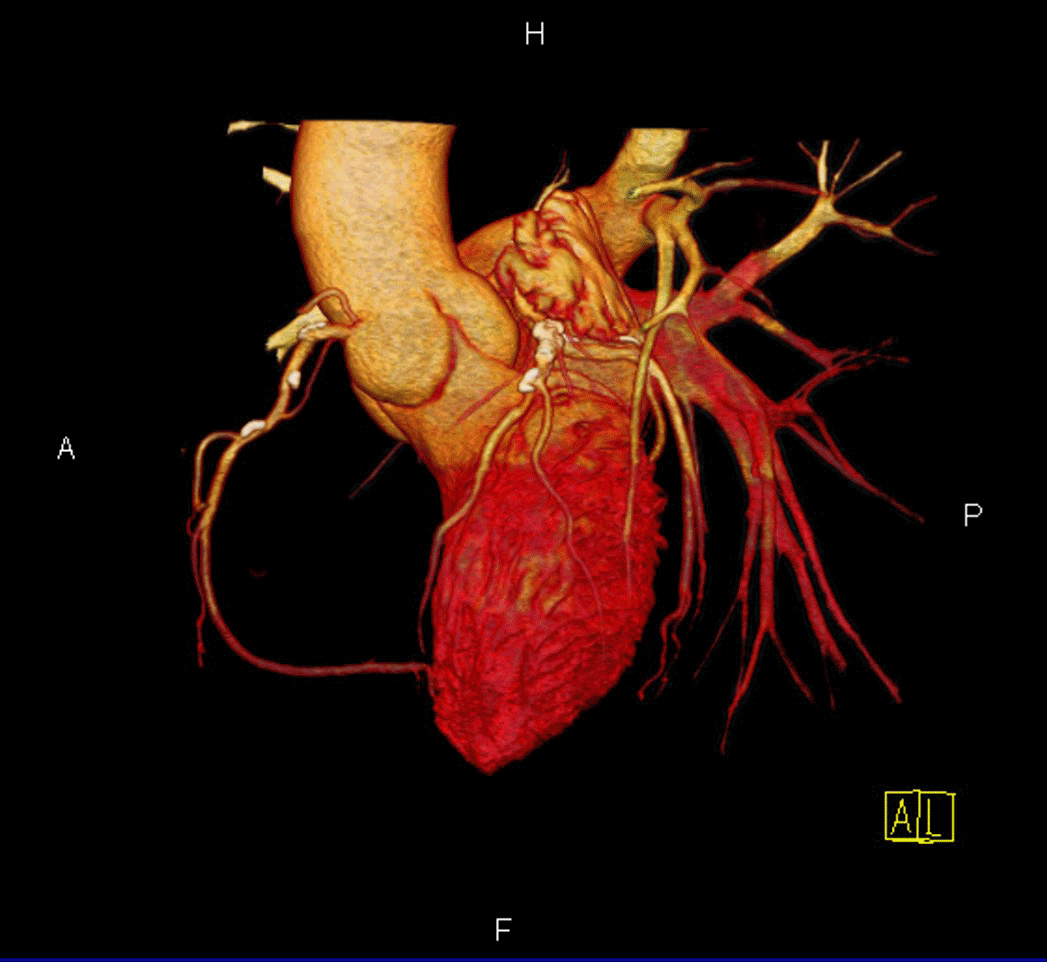 CTA Coronary Angiogram
