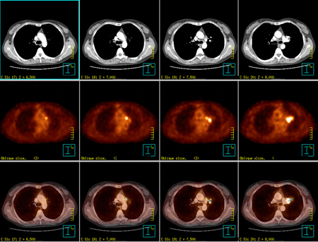 PET/CT Lung |