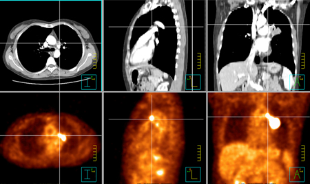 PET/CT Lung |