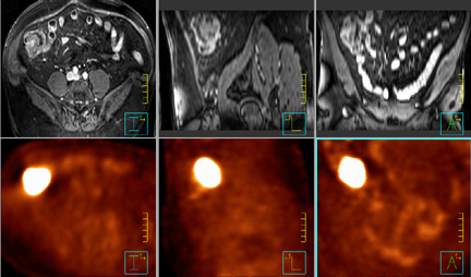 pet scan colon cancer