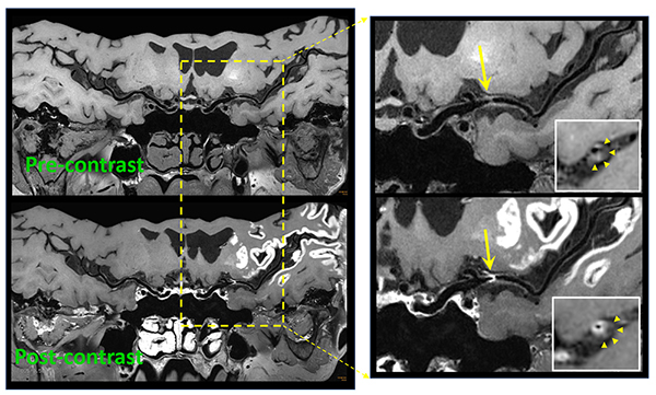 Reformatted intracranial vessel wall images acquired with the whole-brain MR vessel wall imaging technique.