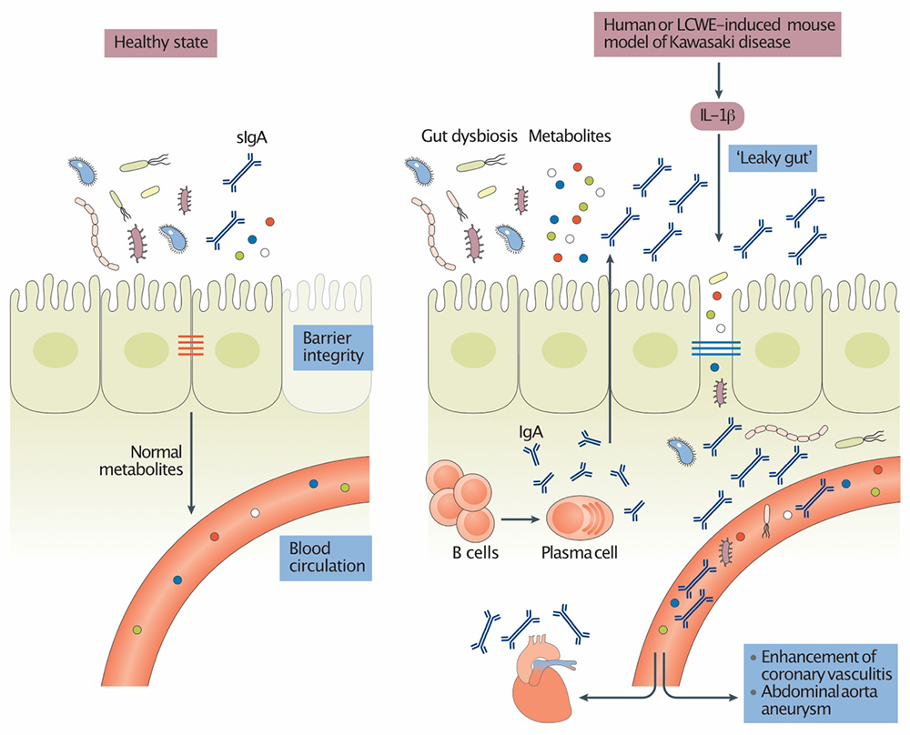 Intestinal Permeability and Gut Microbiome in Kawasaki Disease